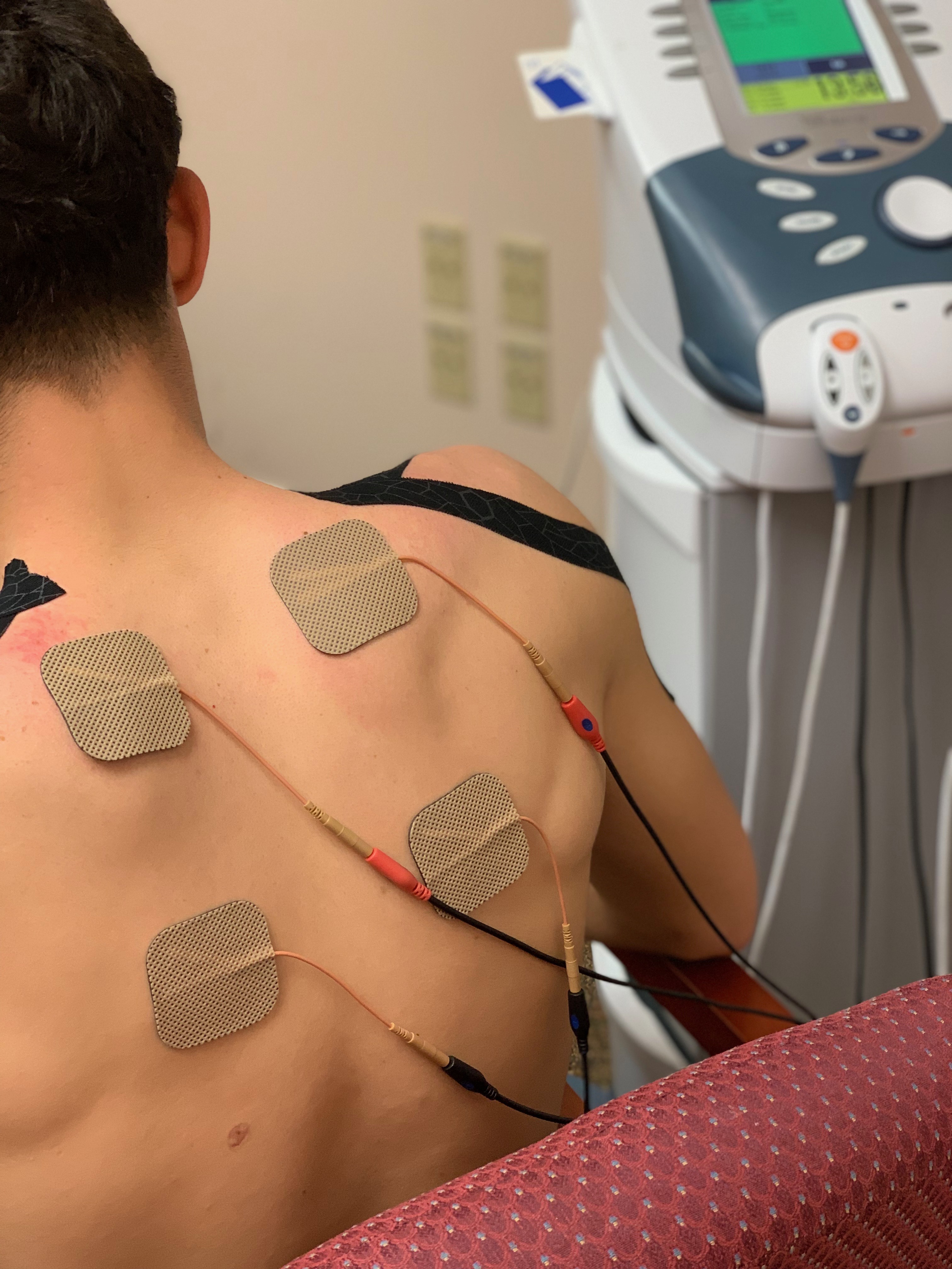 Electrical Stimulation - Healing Star Physical Therapy and Wellness